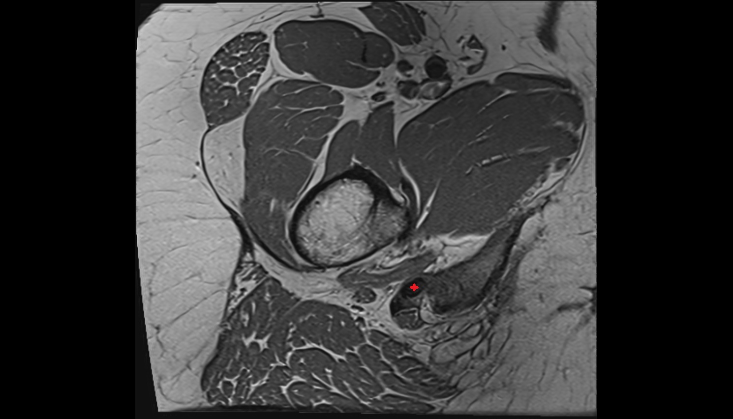Semimembranosus tendon proximal MRI axial  anatomy image-img-00000-00000