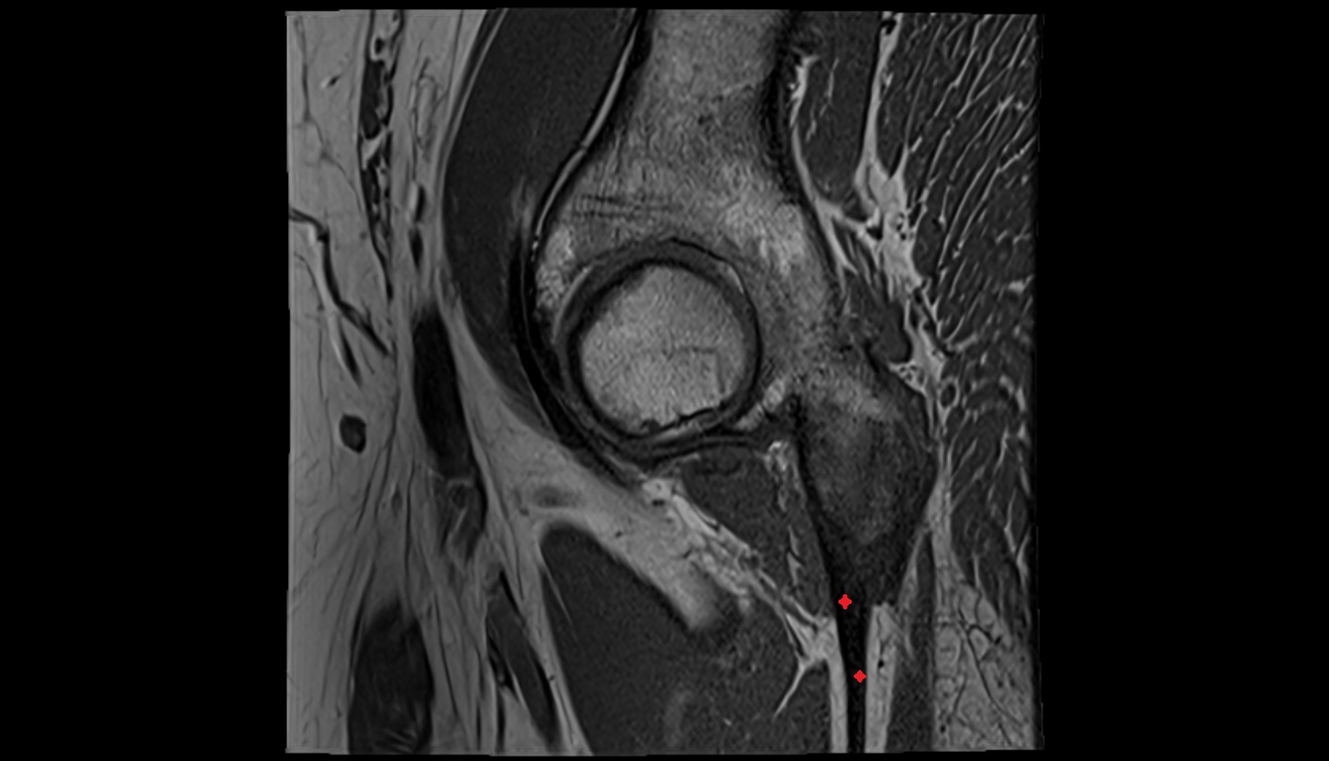 Semimembranosus tendon proximal MRI sag  anatomy image-img-00000-00000