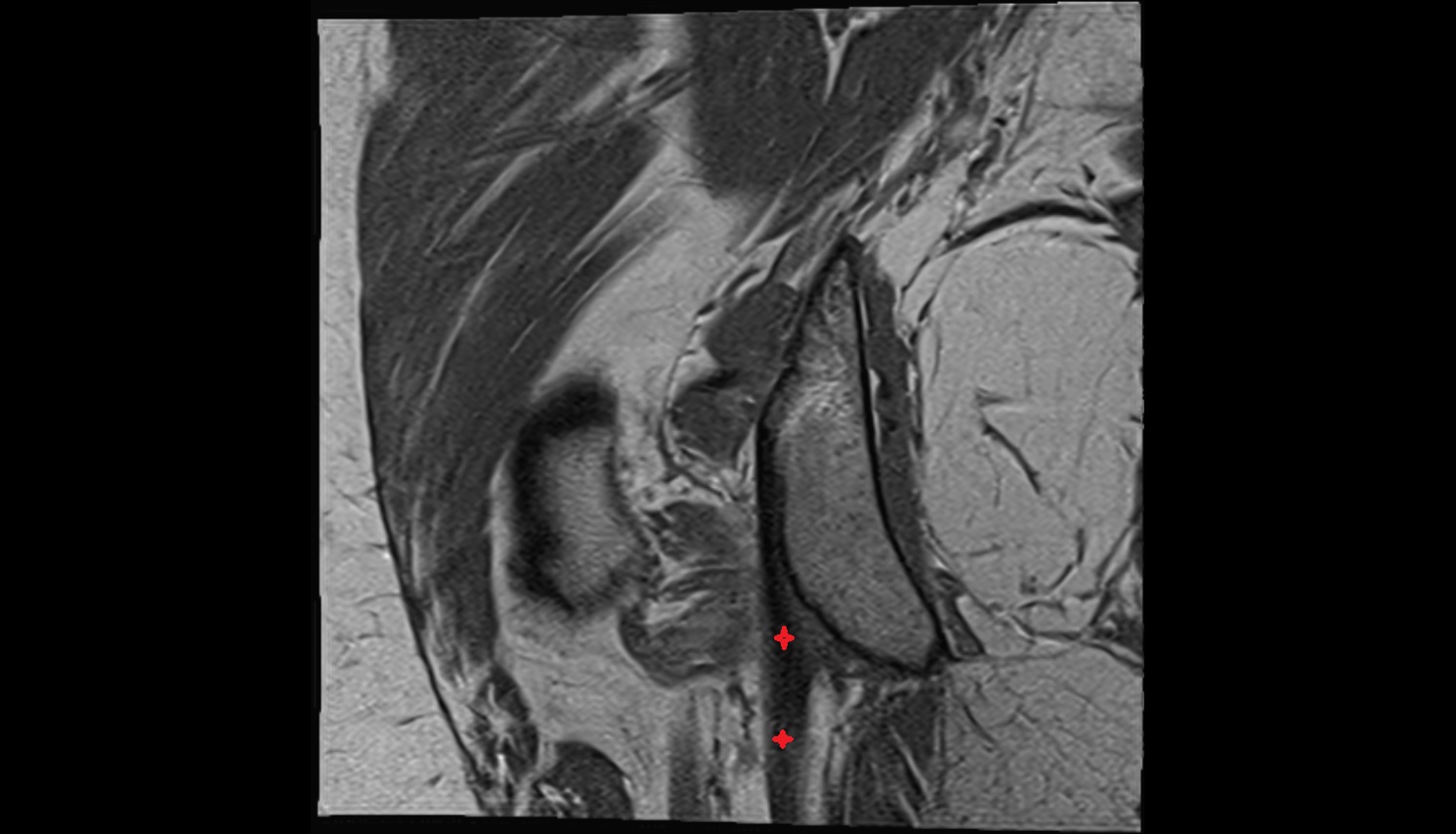 Semimembranosus tendon proximal MRI sag  anatomy image-img-00000-00000_00001