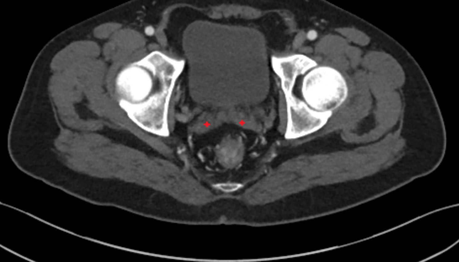 Seminal vesicle  ct  axial anatomy  image-img-00000-00000