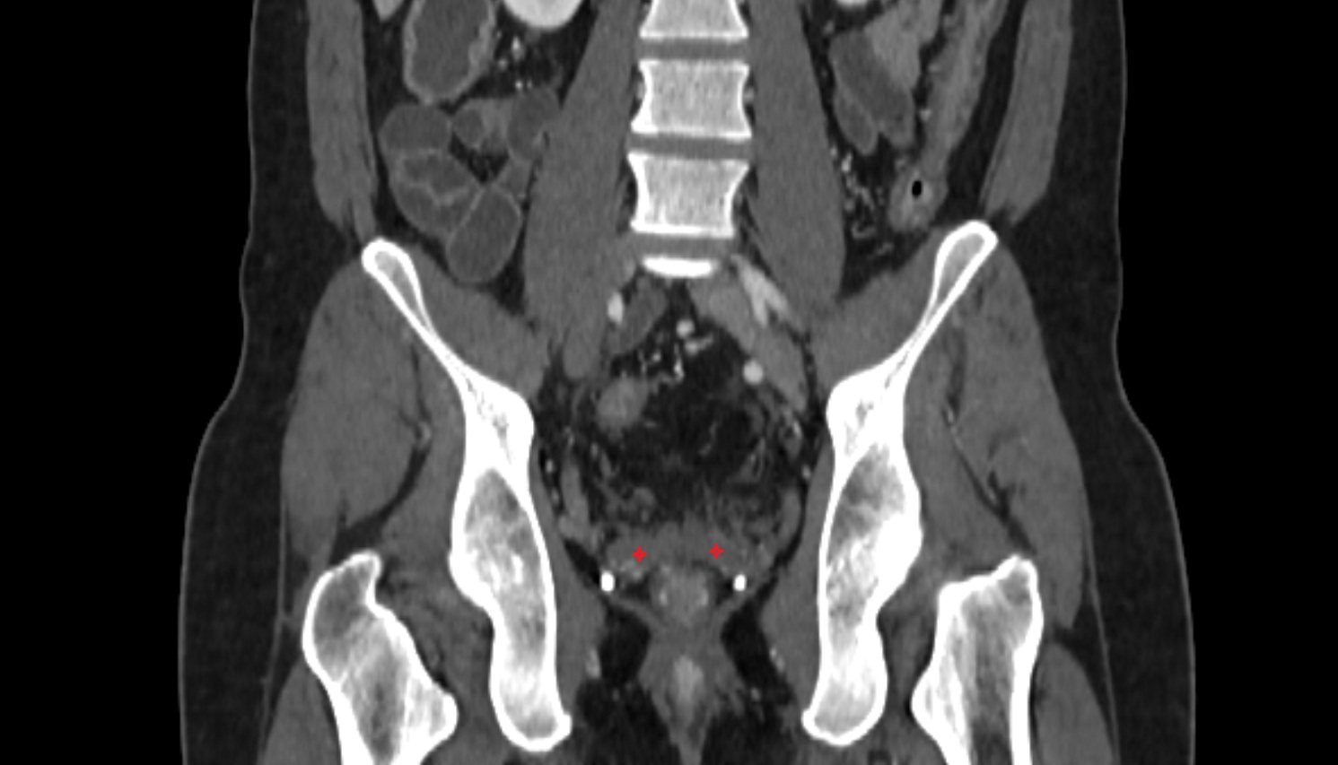 Seminal vesicle  ct coronal anatomy  image-img-00000-00000