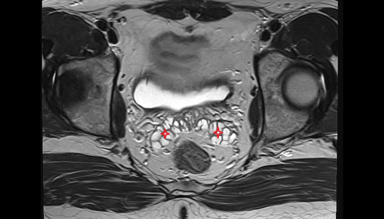 Seminal vesicle  mri  axial anatomy  image-img-00000-00000