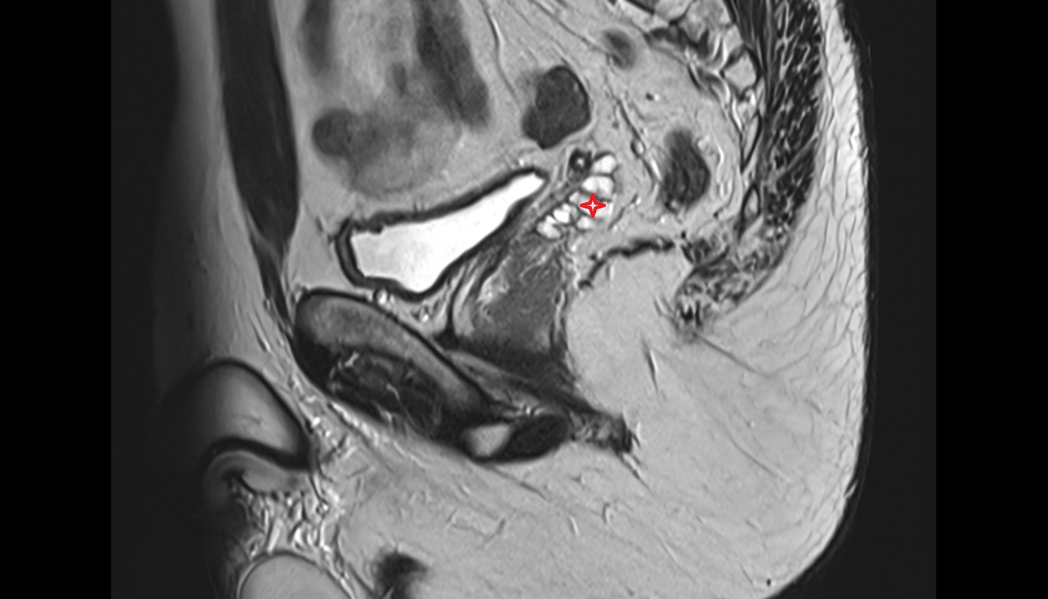 Seminal vesicle  mri sagittal  anatomy  image-img-00000-00000