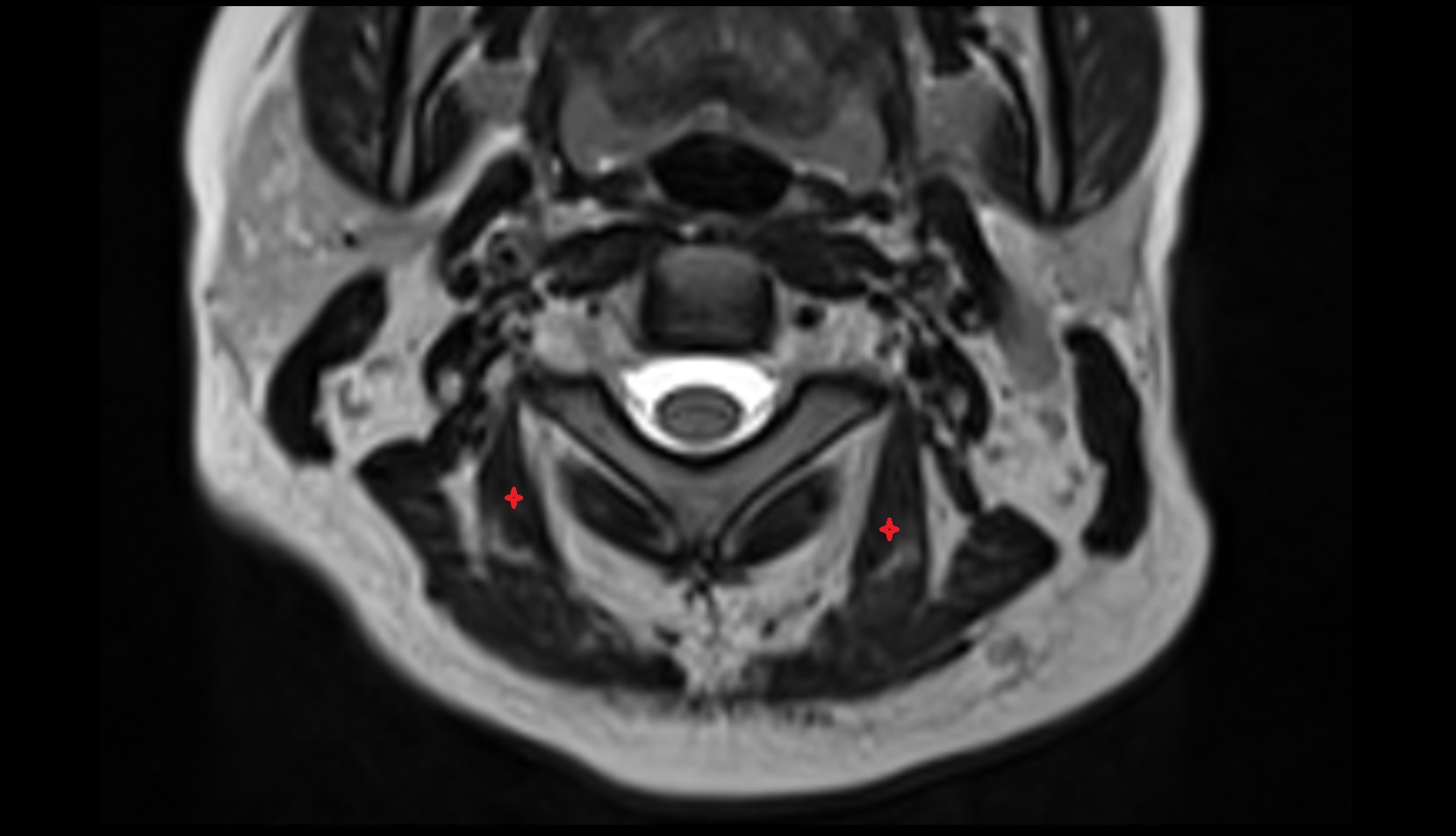 Semispinalis capitis muscle mri axial image