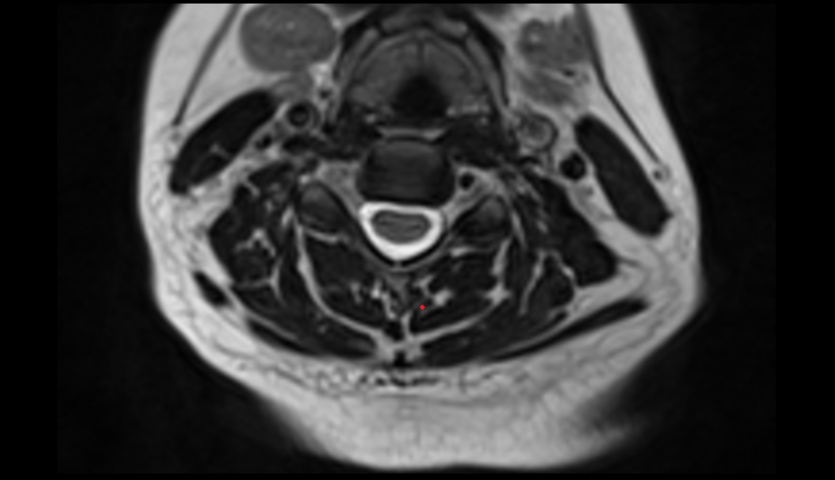 Semispinalis cervicis muscle mri axial image