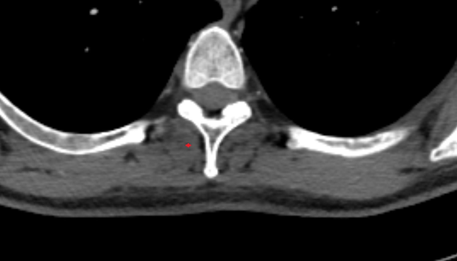 Semispinalis muscle  anatomy  CT  axial  image -img-00000-00000
