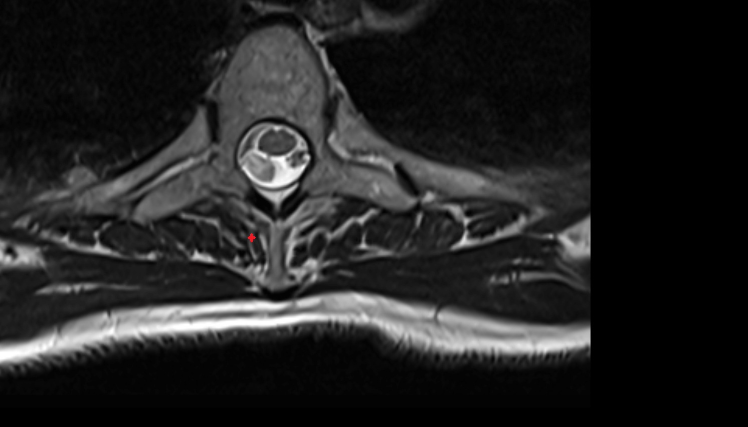 Semispinalis muscle  anatomy MRI axial  image -img-00000-00000