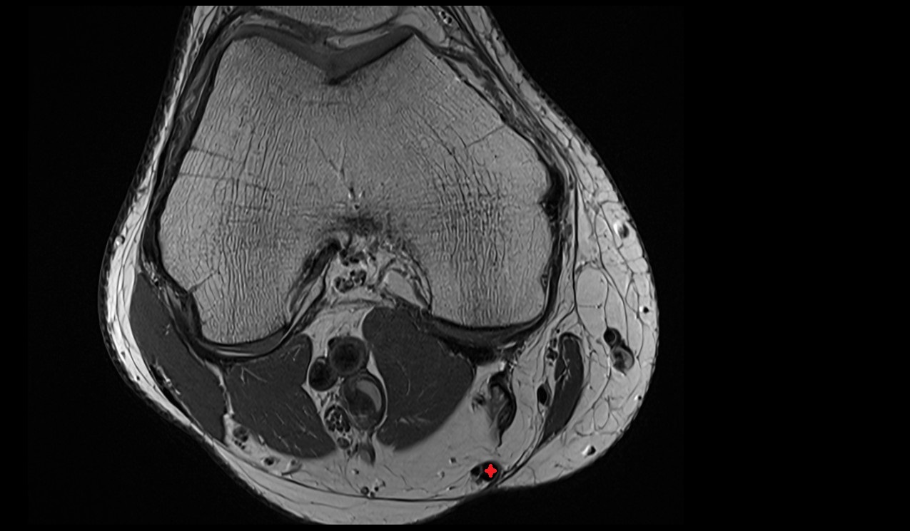 Semitendinosus Tendon  anatomy image