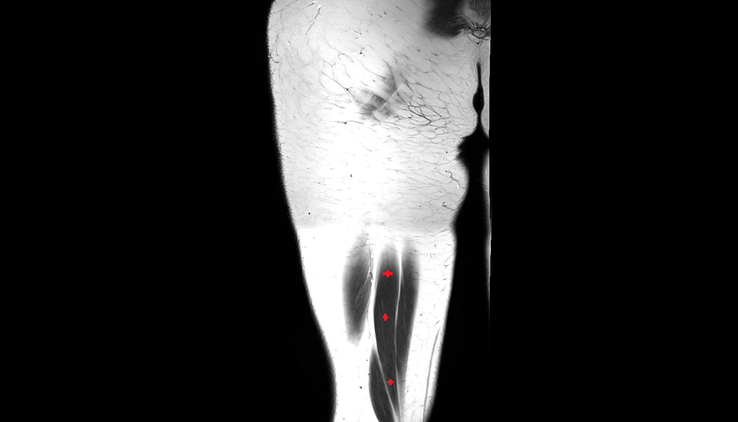 Semitendinosus muscle  MRI coronal anatomy image-img-00000-00000