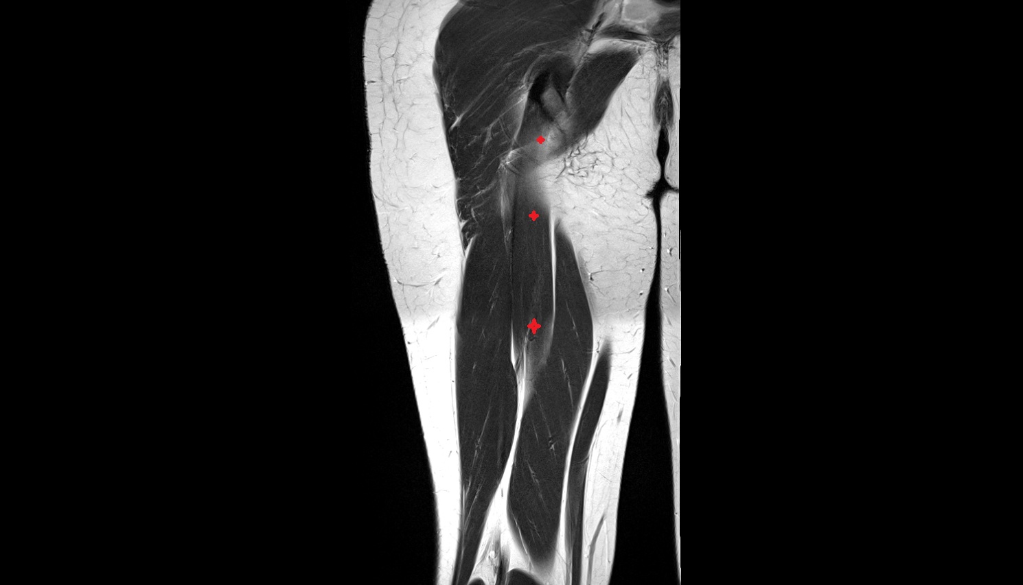 Semitendinosus muscle  MRI coronal anatomy image-img-00000-00000_00001