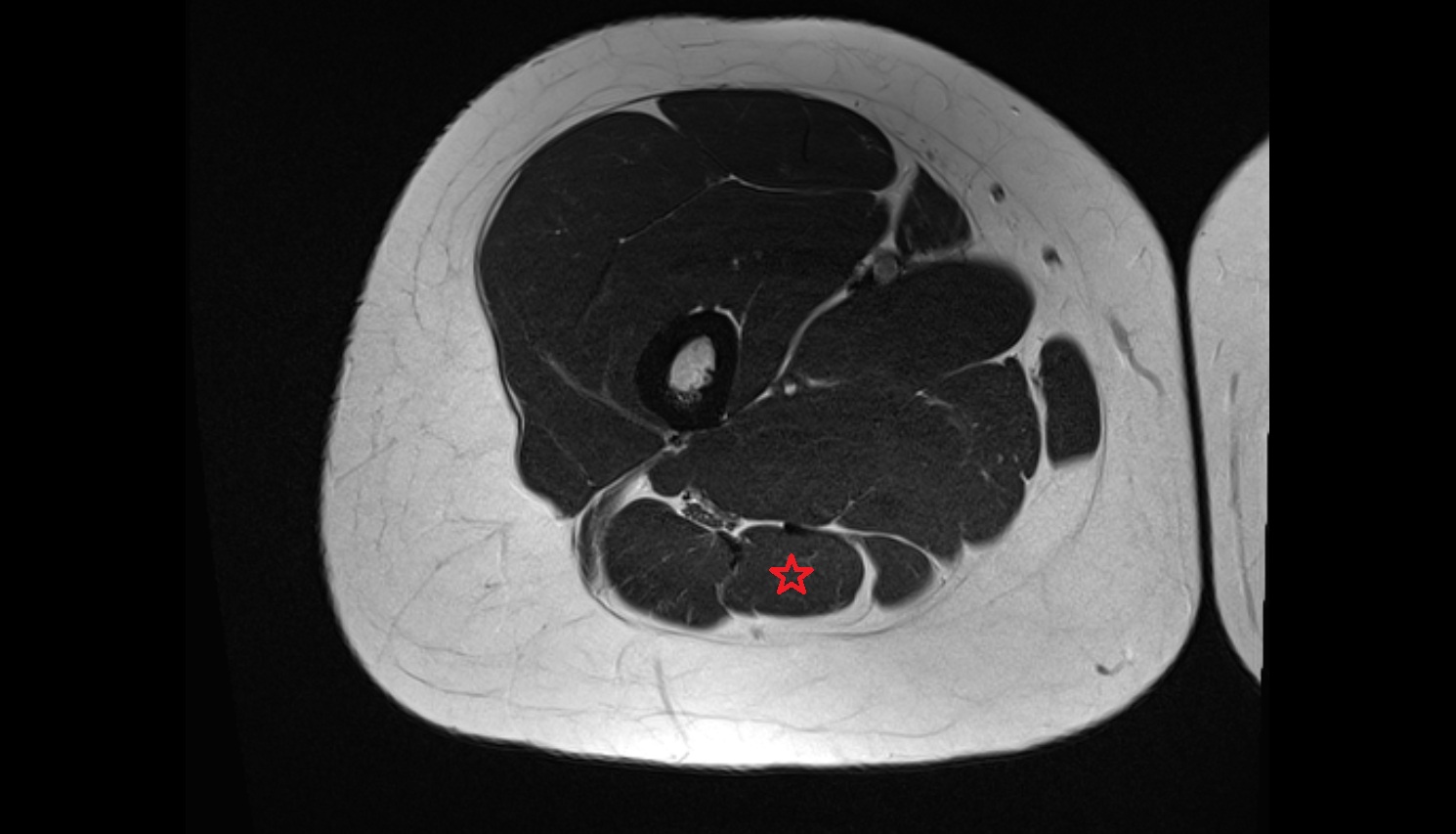 Semitendinosus muscle  MRI coronal anatomy image-img-00000-00000_00002