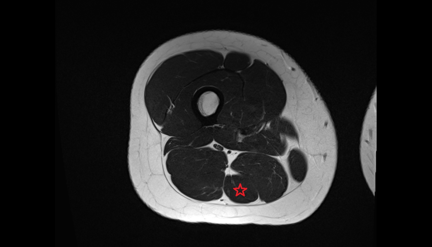 Semitendinosus muscle  MRI coronal anatomy image-img-00000-00000_00003