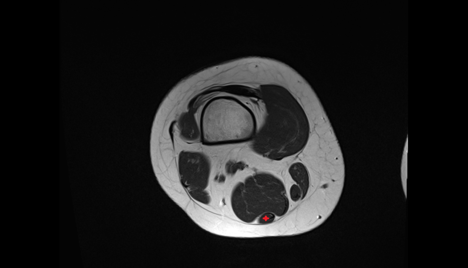 Semitendinosus muscle  MRI coronal anatomy image-img-00000-00000_00004