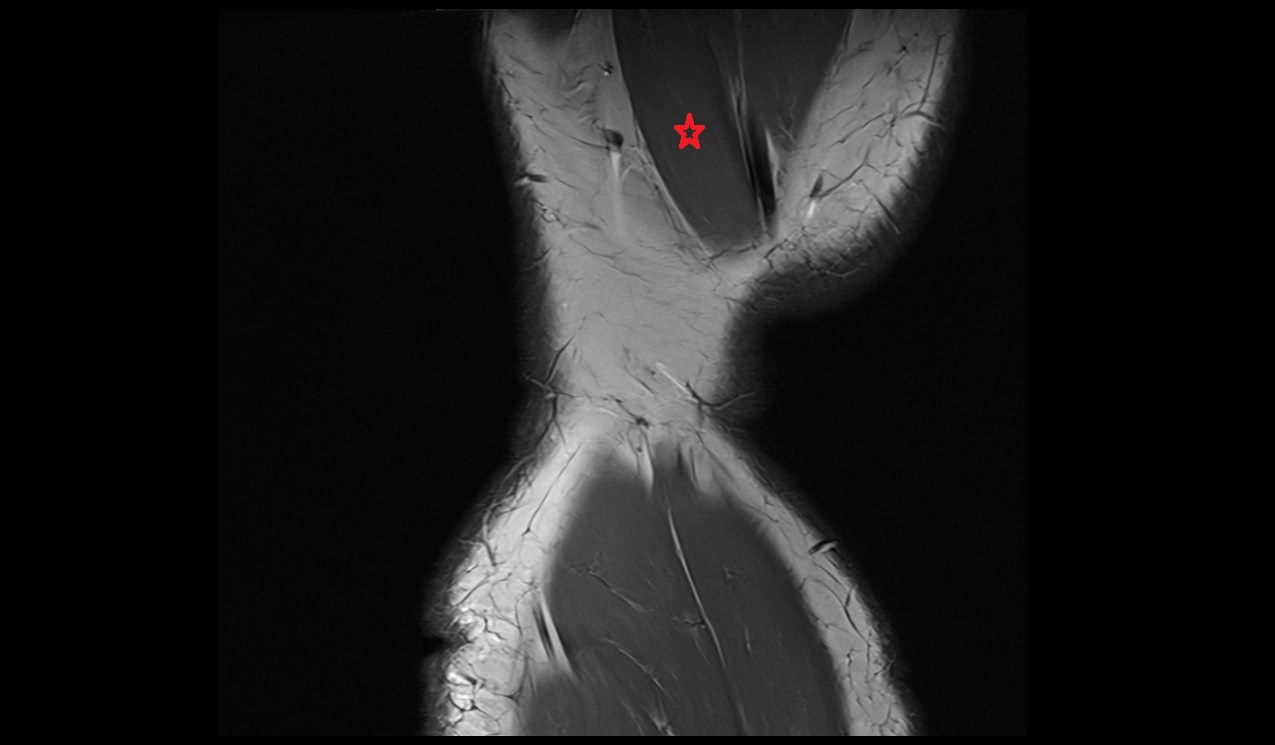 Semitendinosus muscle anatomy image