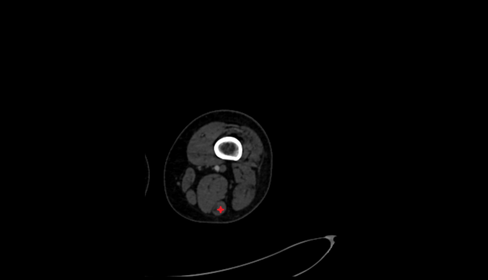 Semitendinosus muscle ct axial 2