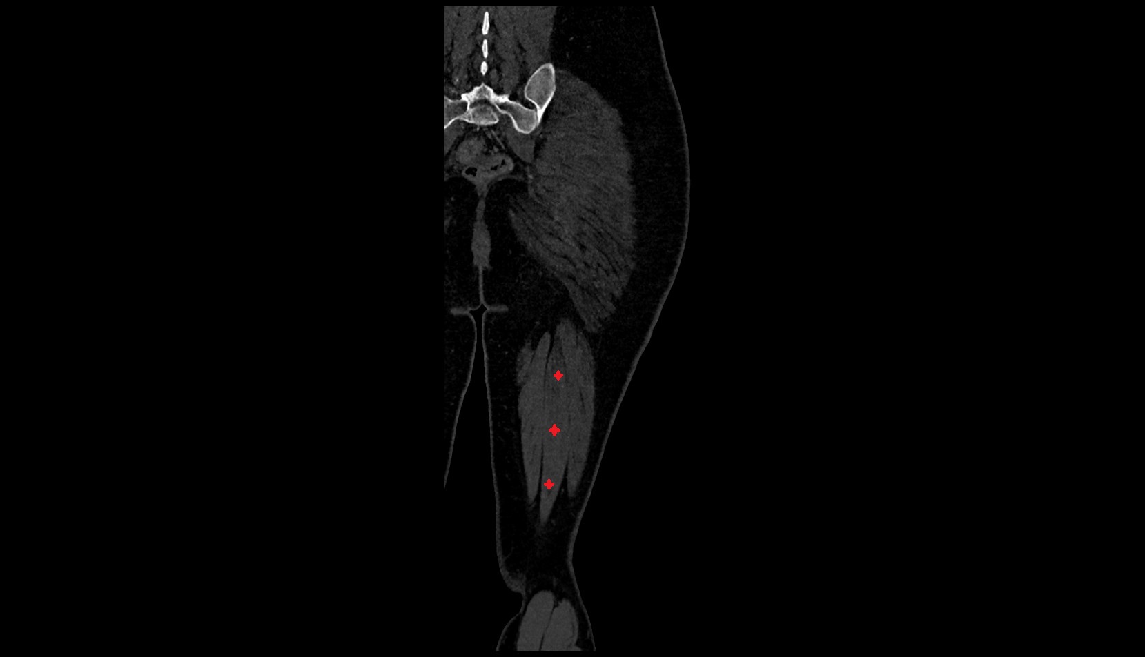 Semitendinosus muscle ct coronal