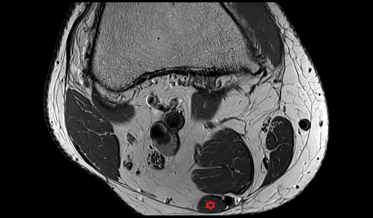 Semitendinosus muscle mri image