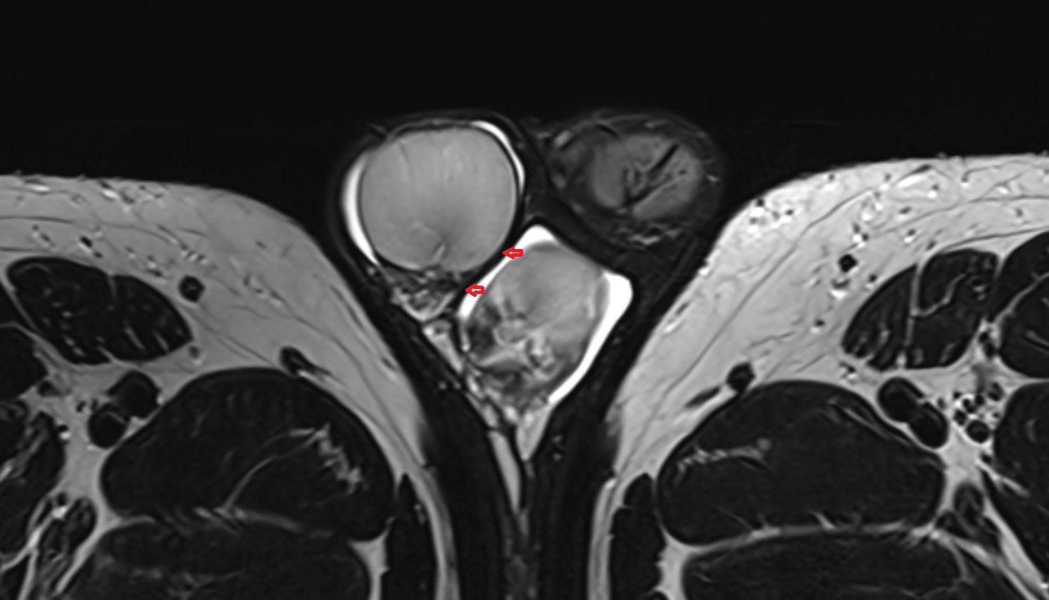 Septum of scrotum  mri axial  anatomy  image-img-00000-00000