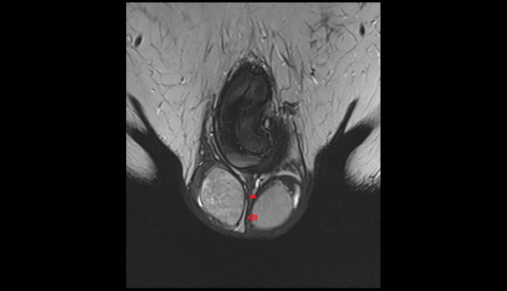 Septum of scrotum mri coronal image