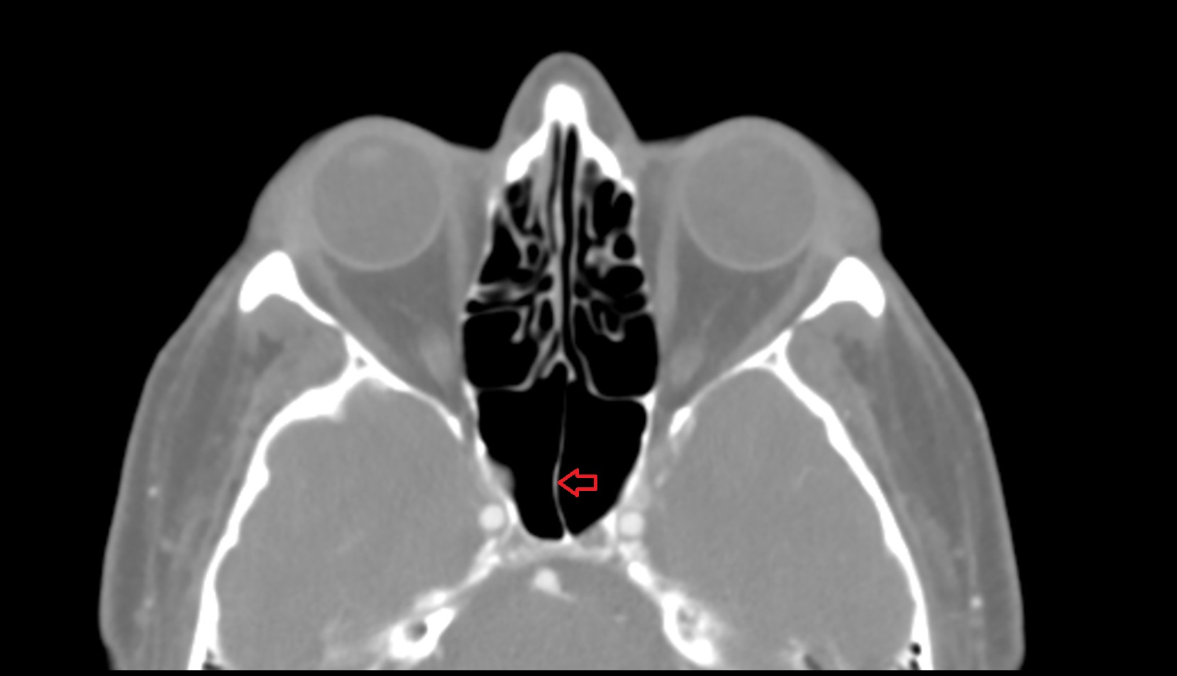 Septum of sphenoid sinus CT AXIAL