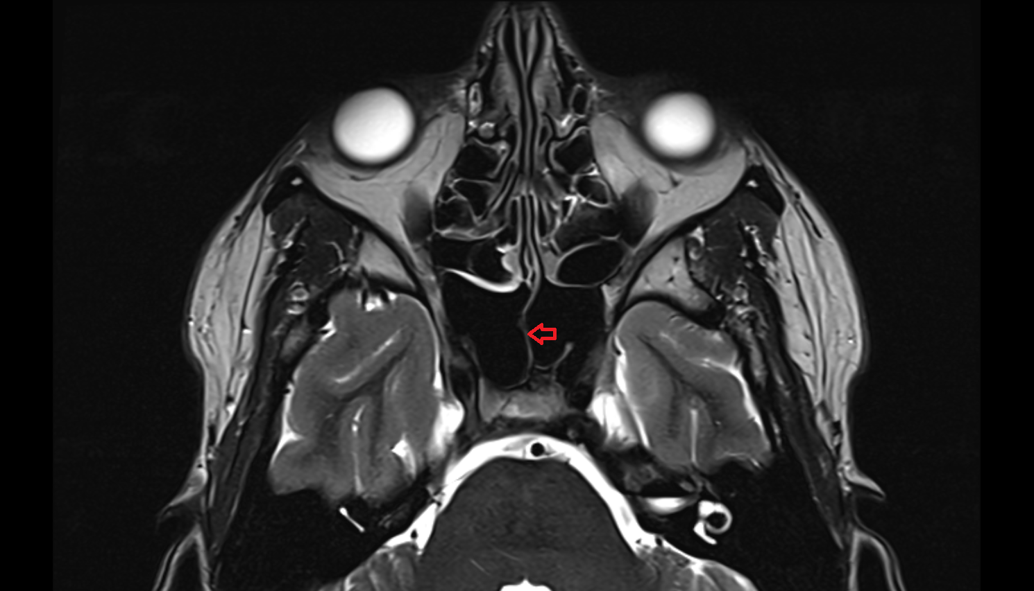 Septum of sphenoid sinus MRI axial  image-img-00000-00000