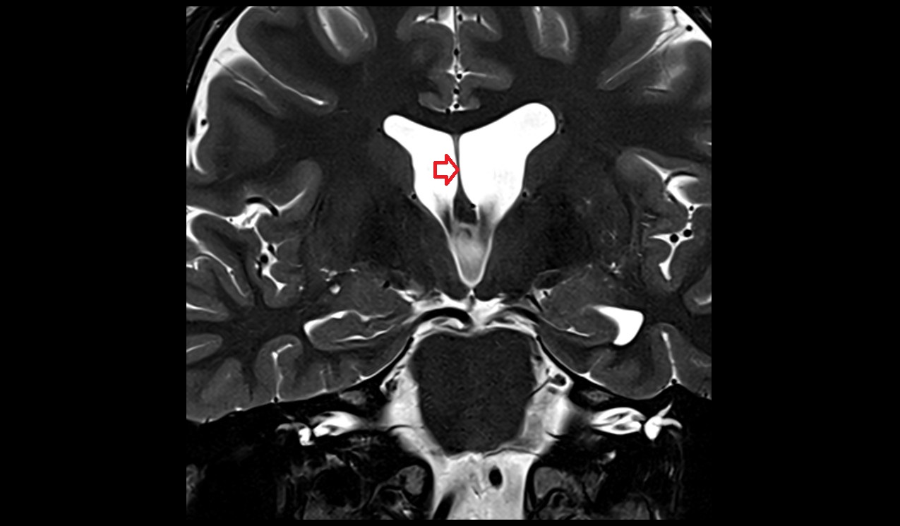 Septum pellucidum mri 3t coronal image