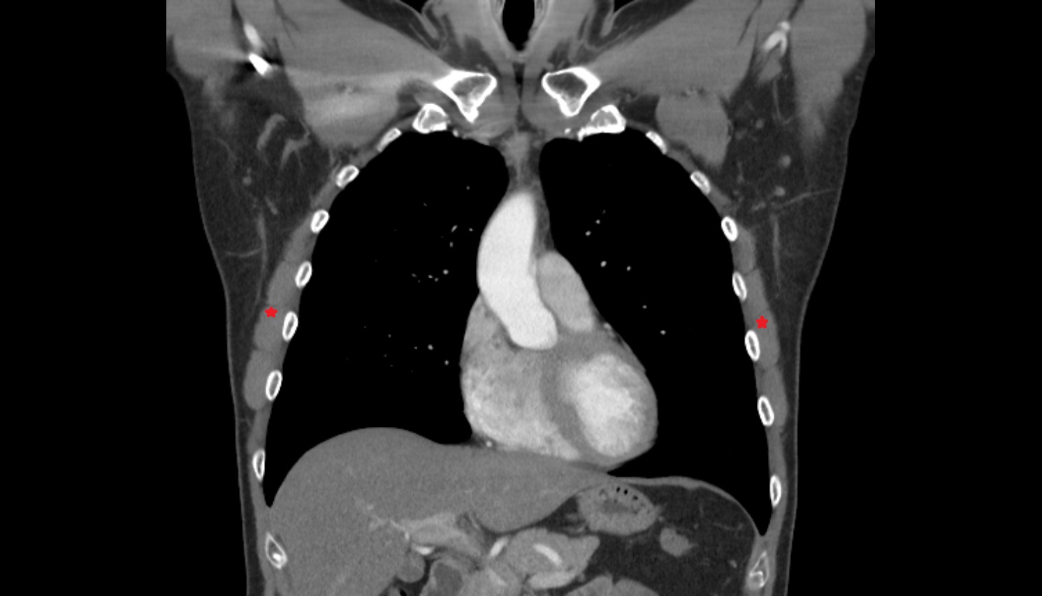 Serratus Anterior Muscle  anatomy  CT coronal  image -img-00000-00000