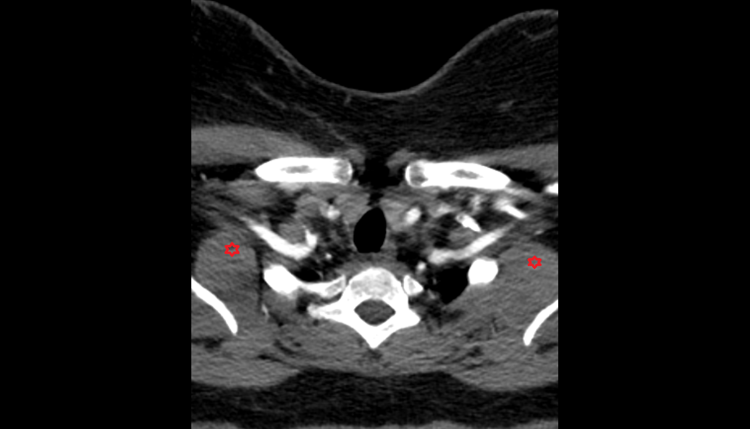Serratus anterior muscle CT axial  image-img-00000-00000