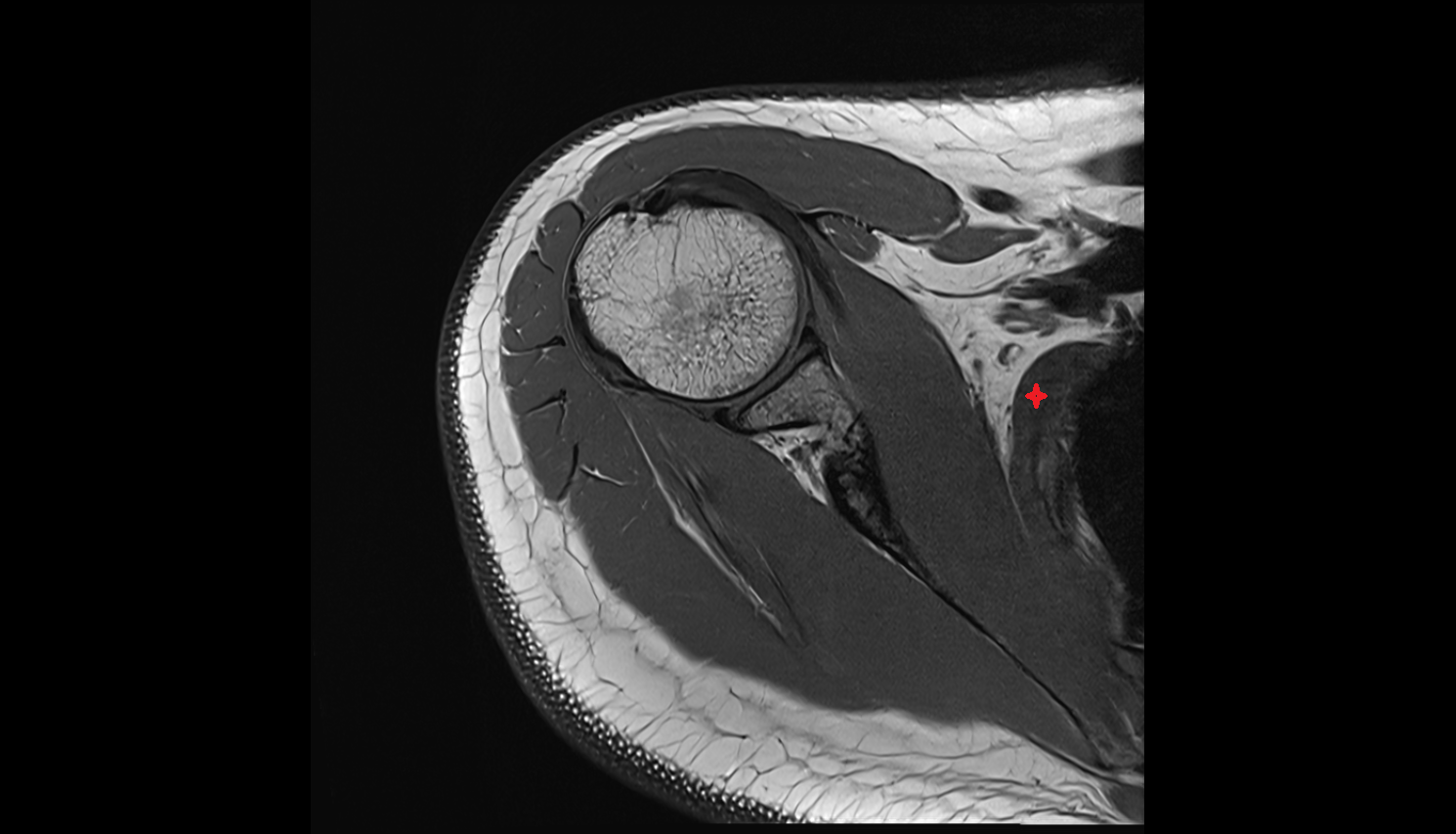 Serratus anterior muscle  axial cross sectional anatomy 3T MRI AI enhanced radiology image-img-00000-00000
