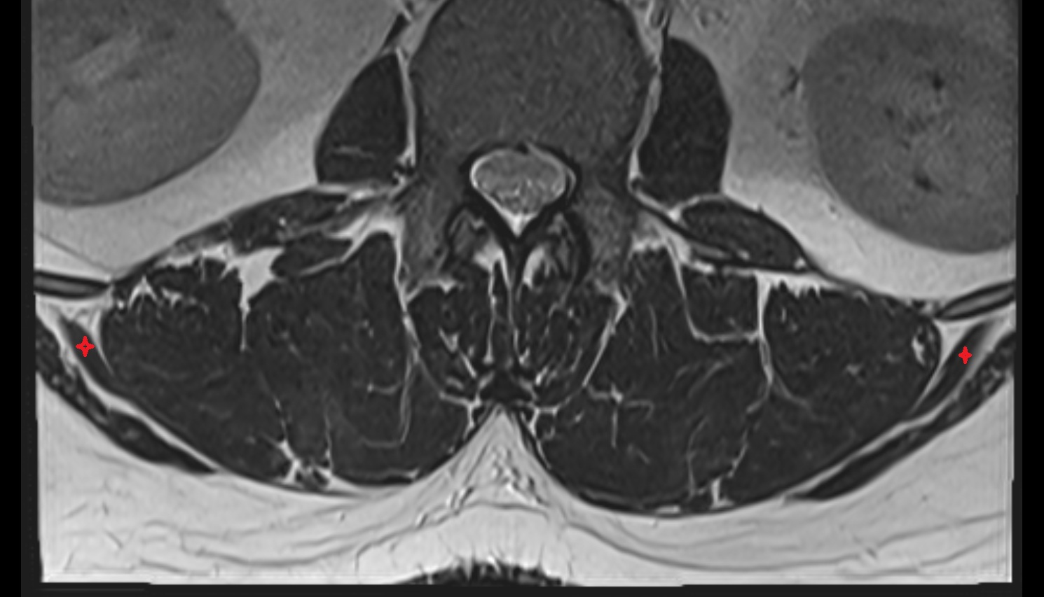 Serratus posterior inferior muscle  mri  axial anatomy  image-img-00000-00000