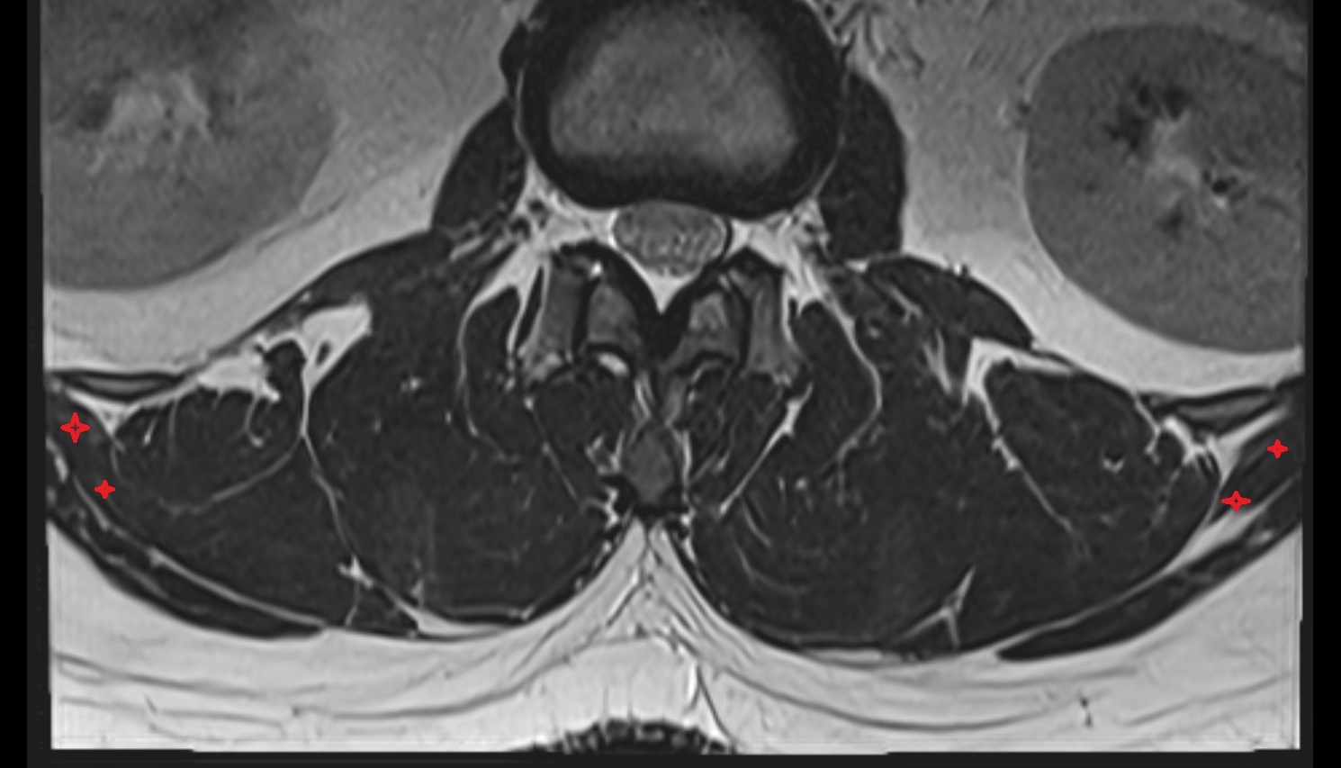 Serratus posterior inferior muscle  mri  axial anatomy  image-img-00000-00000_00001