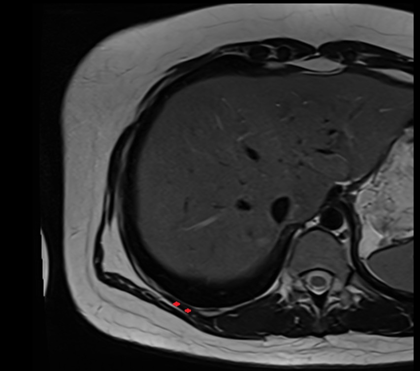 Serratus posterior inferior muscle mri axial image