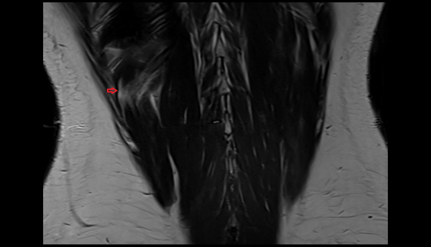 Serratus posterior inferior muscle mri coronal image