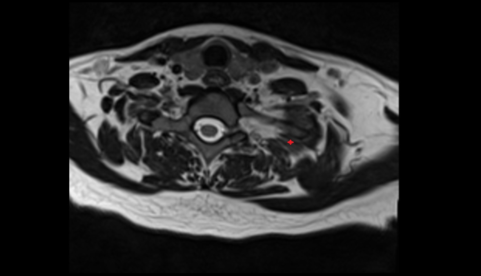 Serratus posterior superior muscle mri axial image