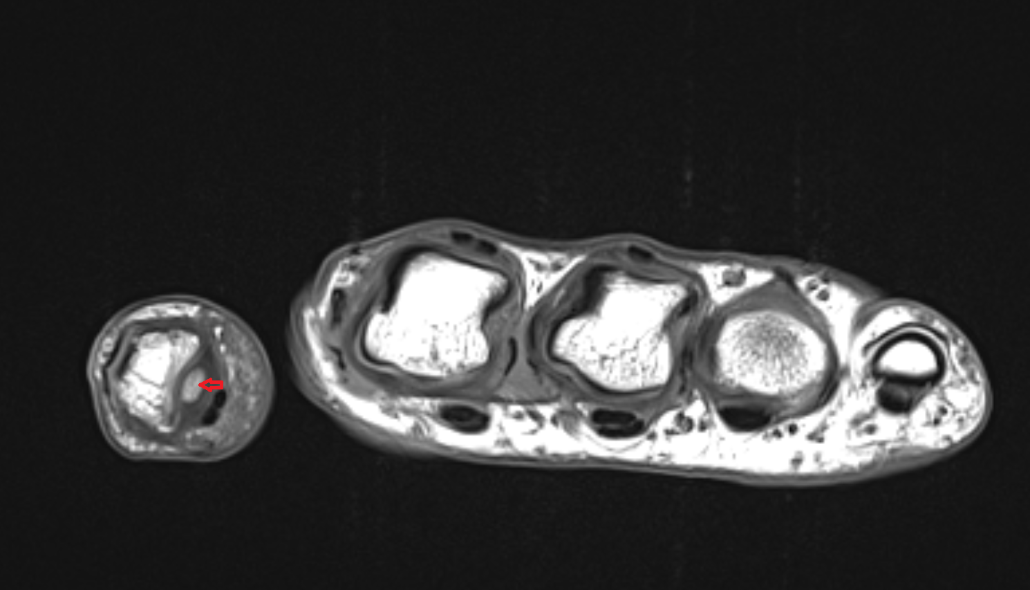 Sesamoid bone of interphalangeal joint  mri  anatomy labelled image-img-00000-00000