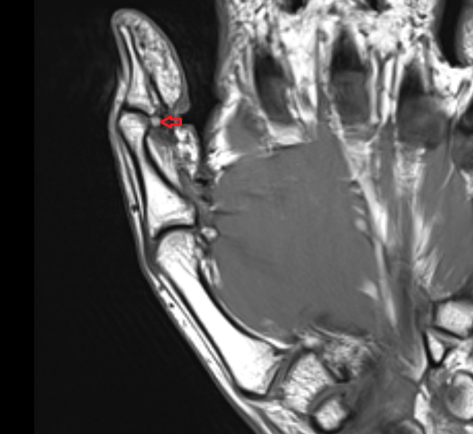 Sesamoid bone of interphalangeal joint  mri  anatomy labelled image-img-00000-00000_00001
