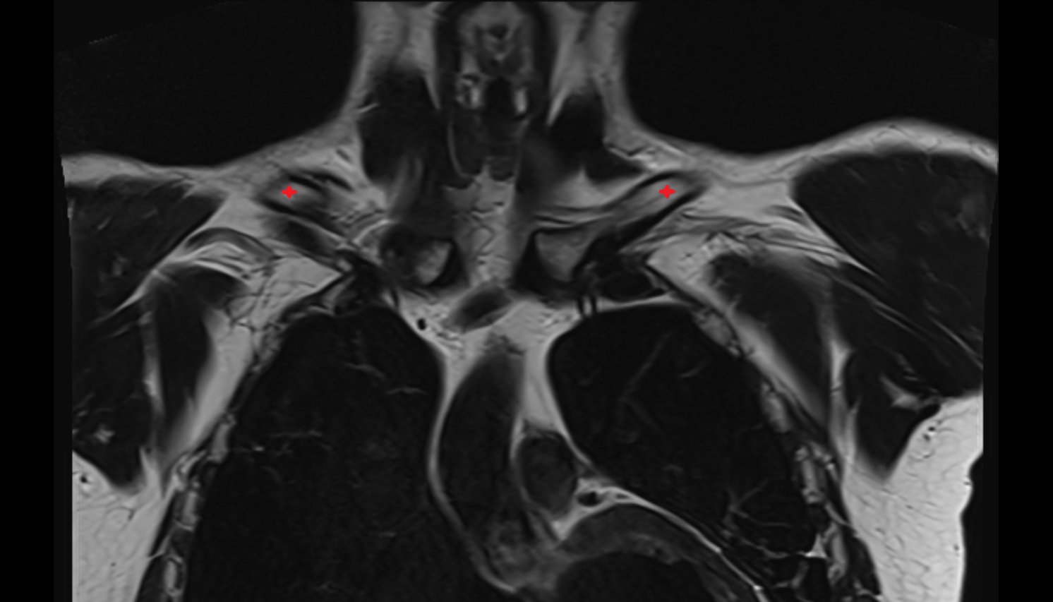 Shaft (Body) of Clavicle anatomy MRI coronal  image -img-00000-00000