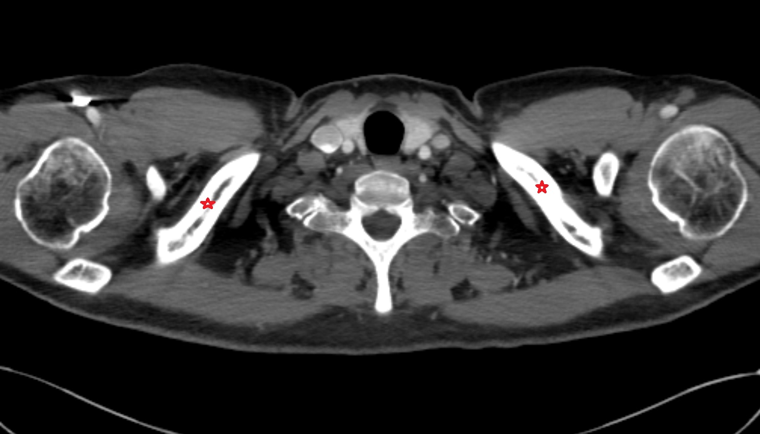 Shaft (Body) of Clavicle anatomy ct axial  image -img-00000-00000