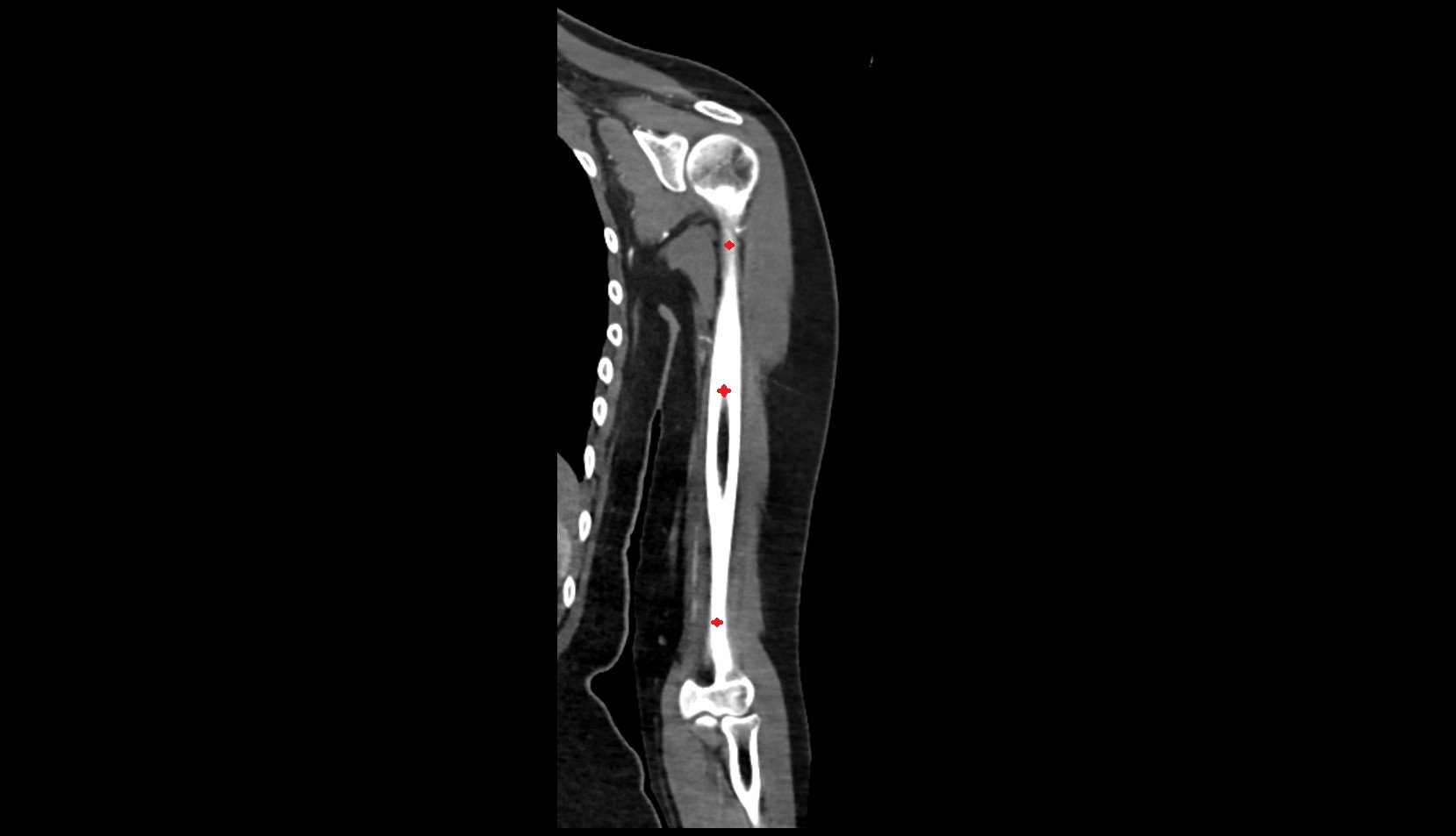 Shaft of humerus ct coronal image