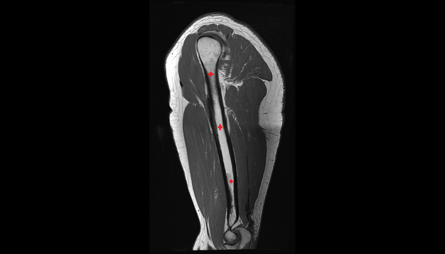Shaft of humerus  sagittal cross sectional anatomy 3T MRI AI enhanced radiology image-img-00000-00000