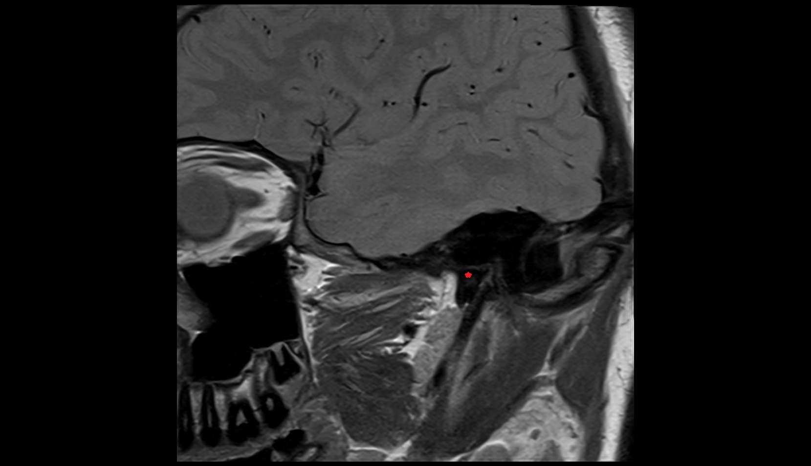 Sheath of styloid process mri