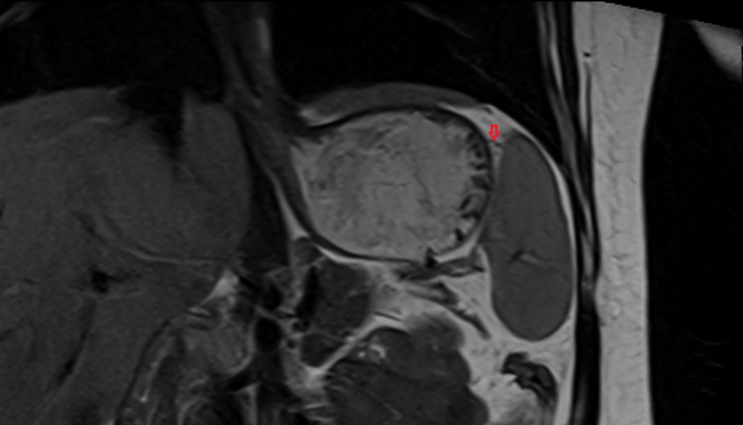 Short gastric arteries   anantomy  MRI  coronal image -img-00000-00000