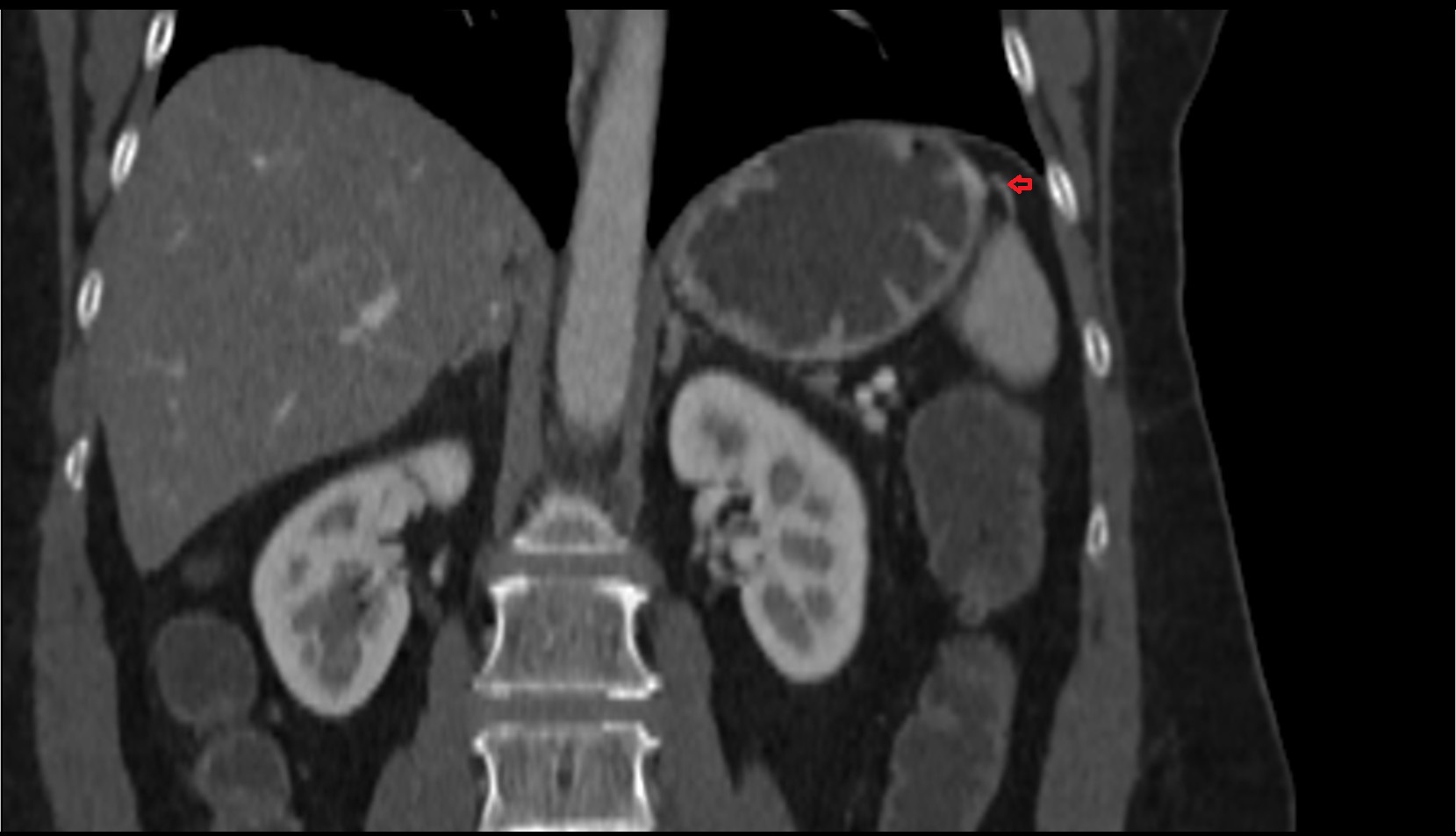 Short gastric arteries ct coronal