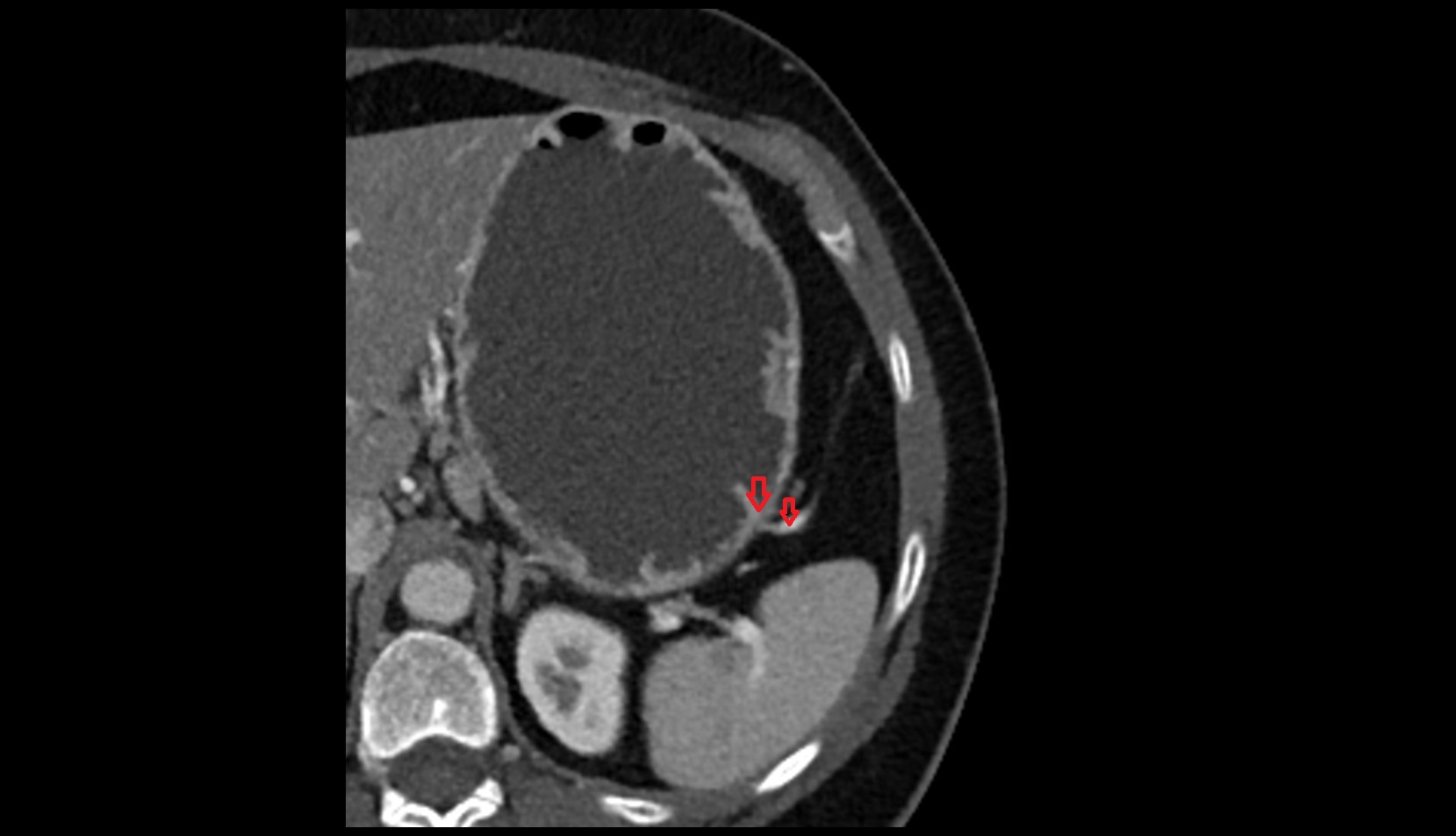 Short gastric veins CT axial image