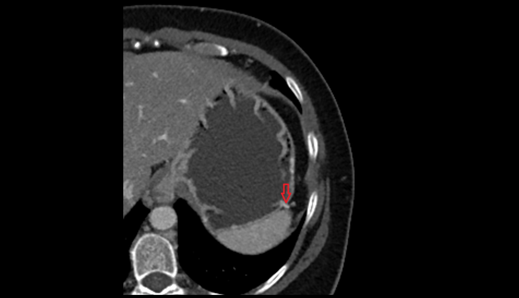 Short gastric veins CT axial image 1