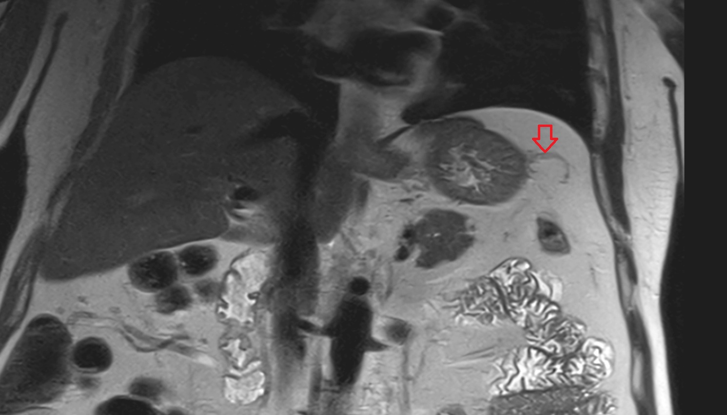 Short gastric veins  MRI coronal  anatomy  image -img-00000-00000