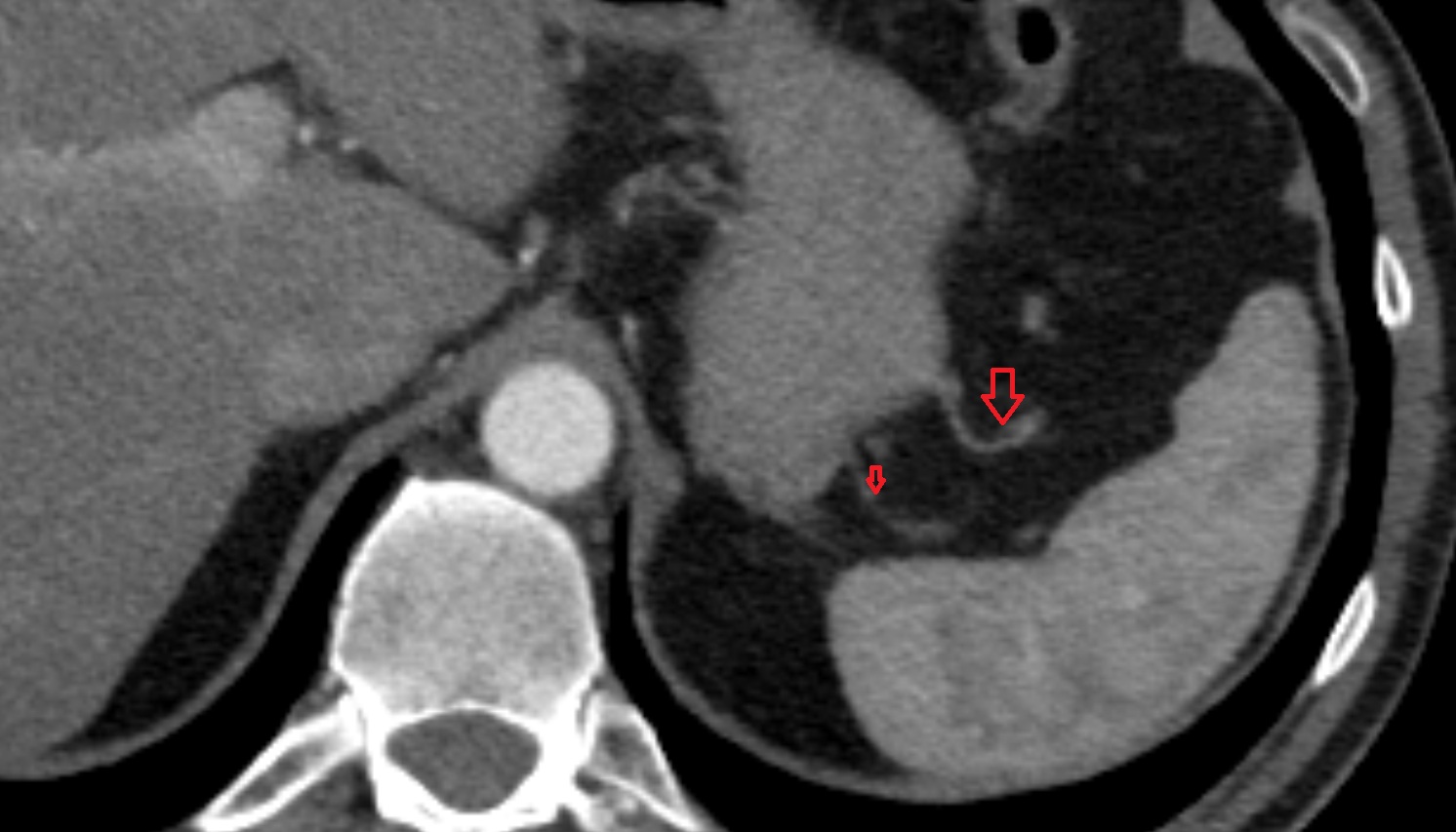 Short gastric veins  anatomy CT axial  image -img-00000-00000