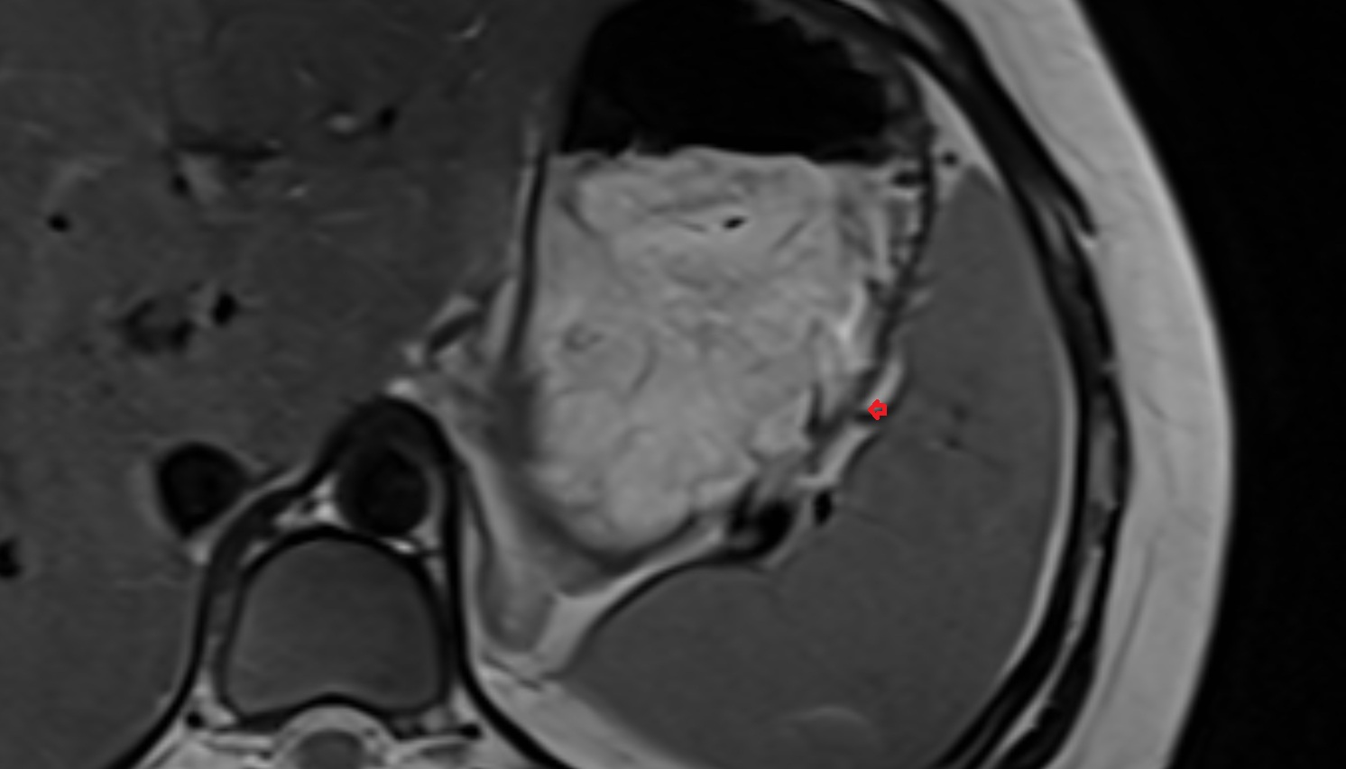 Short gastric veins  anatomy MRI axial  image -img-00000-00000