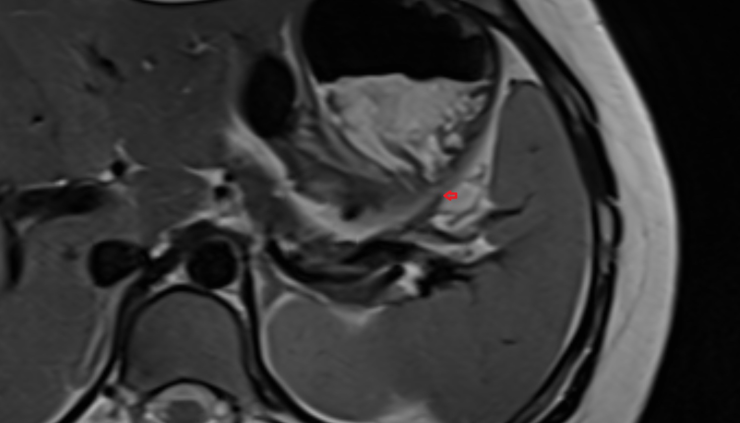 Short gastric veins  anatomy MRI axial  image -img-00000-00000_00001