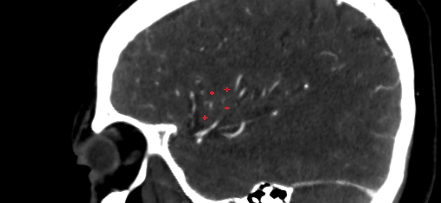 Short gyri of insula  CT sag  cross sectional anatomy radiology image